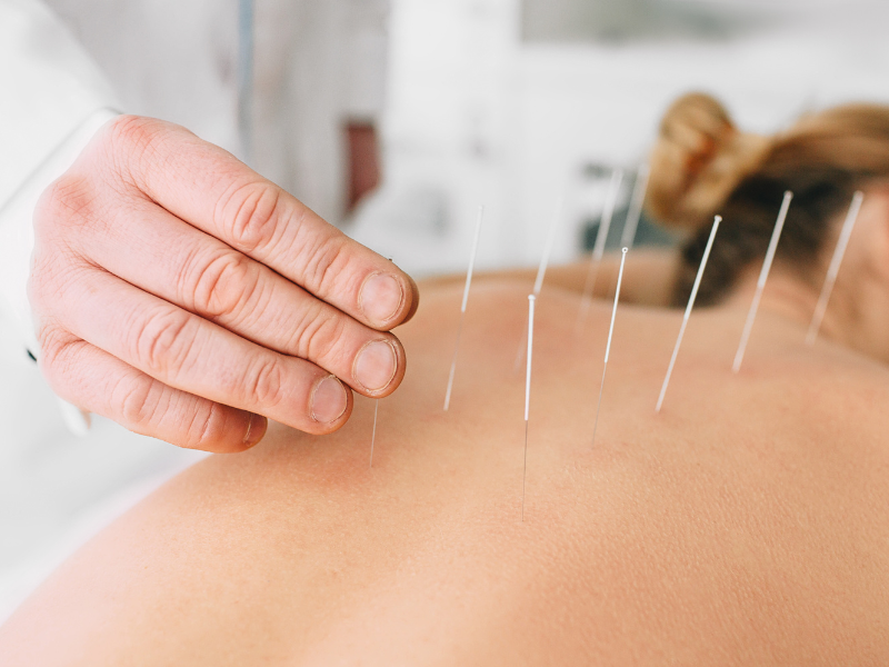 fitness business ideas - acupuncture